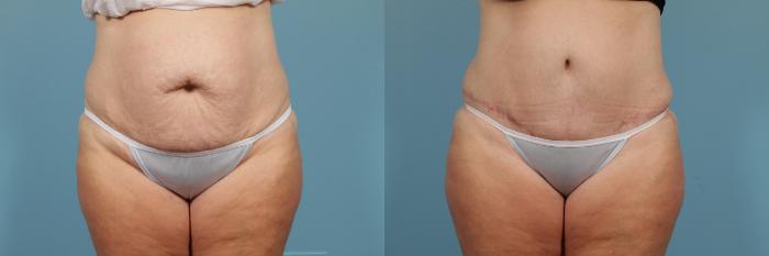 Before & After Tummy Tuck by Dr. Mustoe Case 213 View #1 View in Chicago, IL