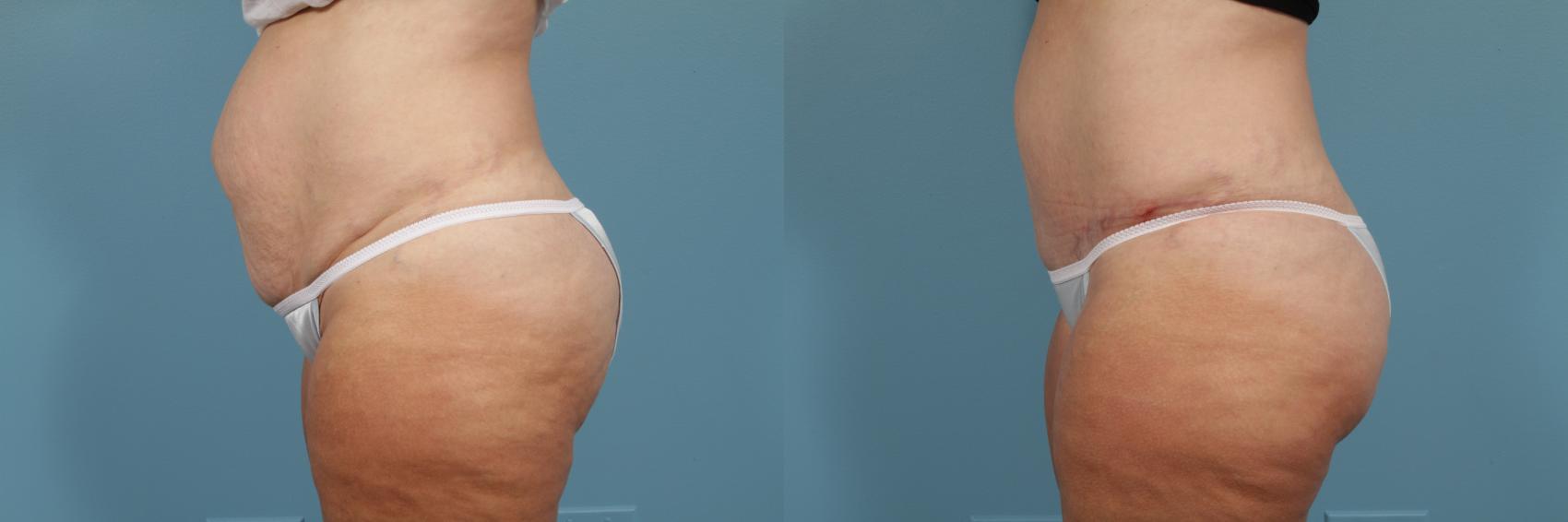 Before & After Tummy Tuck by Dr. Mustoe Case 213 View #2 View in Chicago, IL