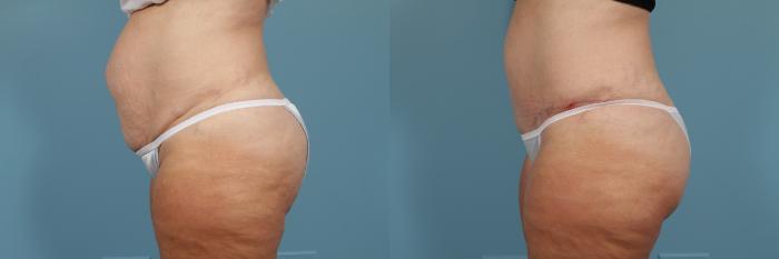 Before & After Tummy Tuck by Dr. Mustoe Case 213 View #2 View in Chicago, IL