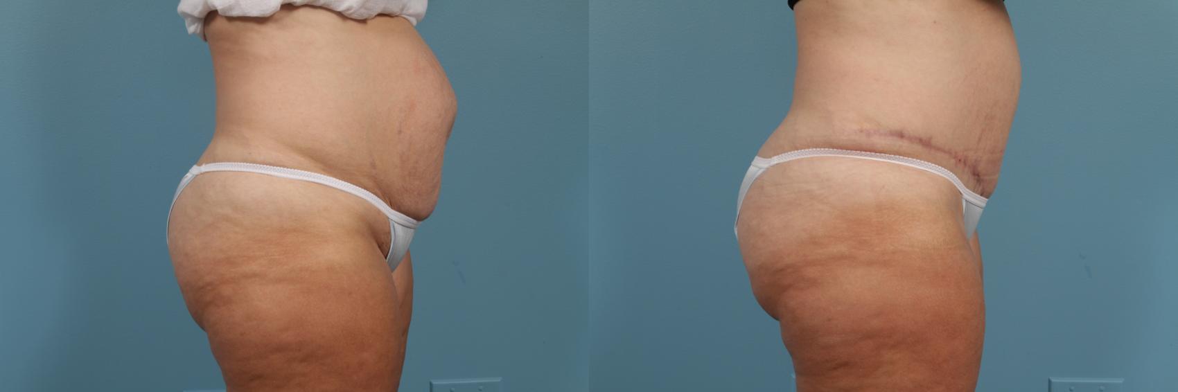 Before & After Tummy Tuck by Dr. Mustoe Case 213 View #3 View in Chicago, IL