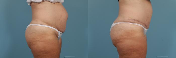 Before & After Tummy Tuck by Dr. Mustoe Case 213 View #3 View in Chicago, IL