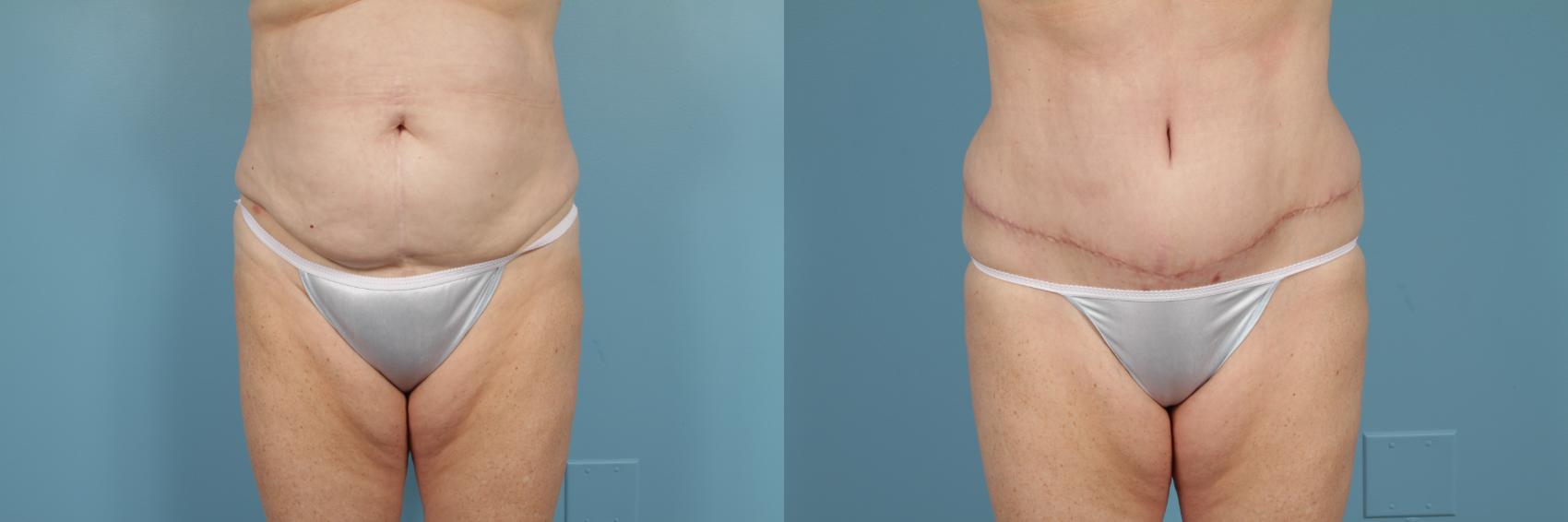 Before & After Tummy Tuck by Dr. Mustoe Case 222 View #2 View in Chicago, IL