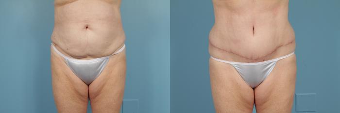 Before & After Tummy Tuck by Dr. Mustoe Case 222 View #2 View in Chicago, IL