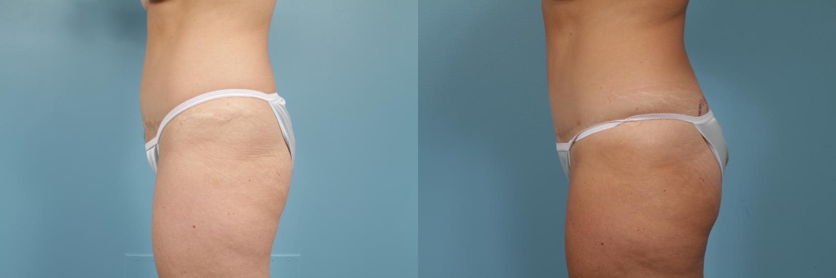 Before & After Tummy Tuck by Dr. Mustoe Case 251 View #2 View in Chicago, IL