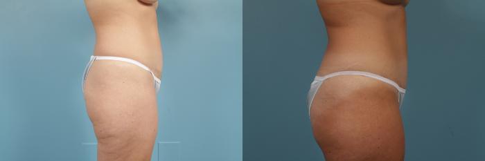 Before & After Tummy Tuck by Dr. Mustoe Case 251 View #3 View in Chicago, IL