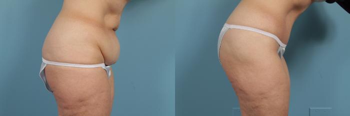 Before & After Tummy Tuck by Dr. Mustoe Case 260 View #4 View in Chicago, IL