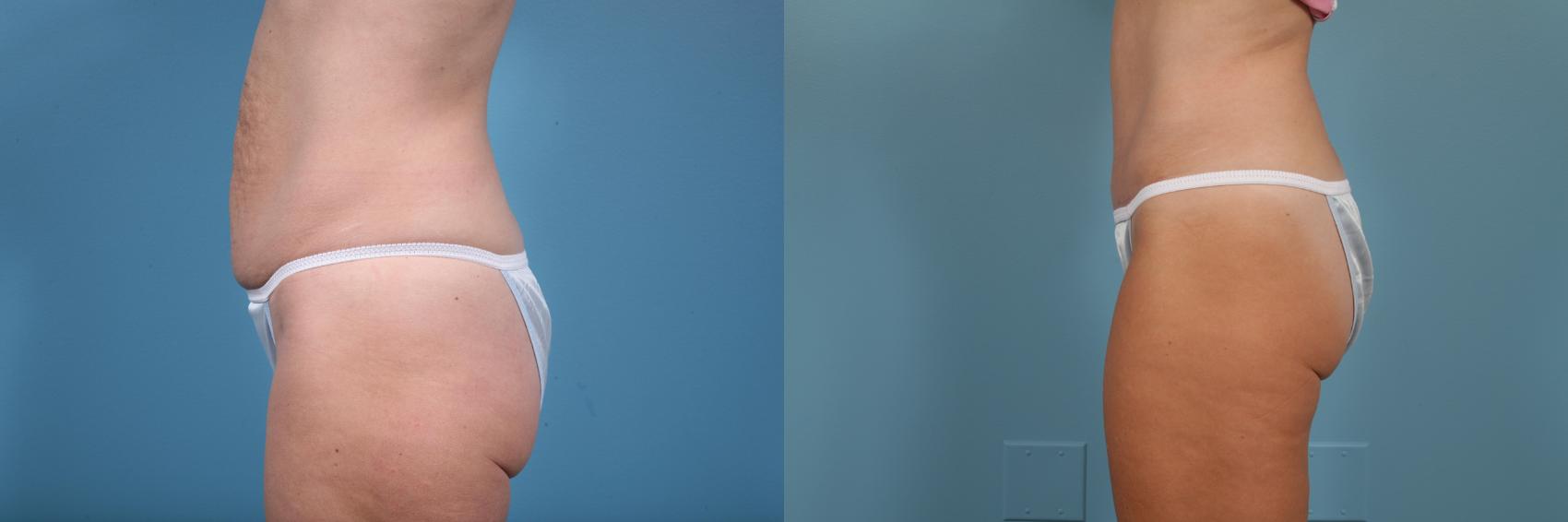 Before & After Tummy Tuck by Dr. Mustoe Case 261 View #2 View in Chicago, IL