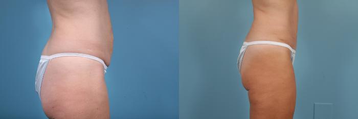 Before & After Tummy Tuck by Dr. Mustoe Case 261 View #3 View in Chicago, IL