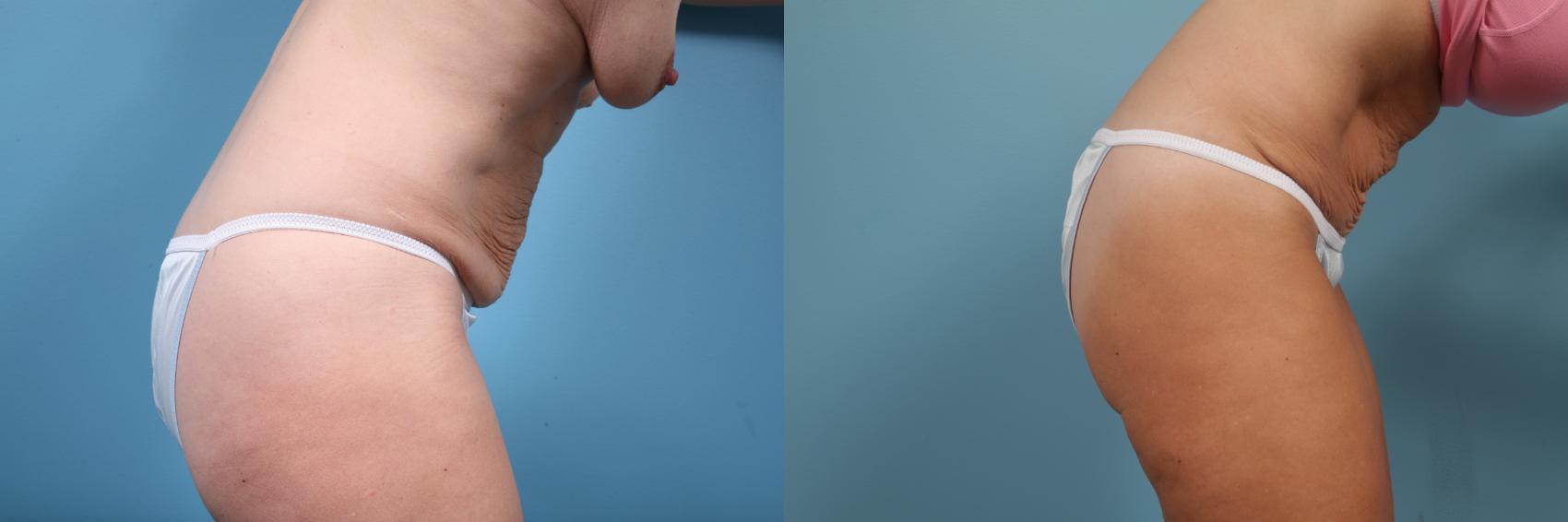 Before & After Tummy Tuck by Dr. Mustoe Case 261 View #4 View in Chicago, IL