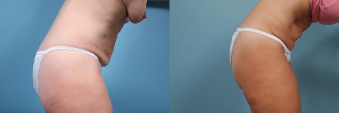 Before & After Tummy Tuck by Dr. Mustoe Case 261 View #4 View in Chicago, IL