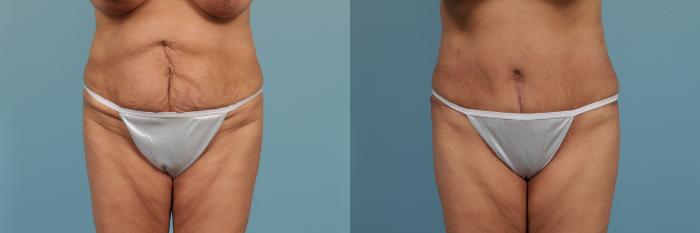 Before & After Tummy Tuck by Dr. Mustoe Case 266 View #1 View in Chicago, IL