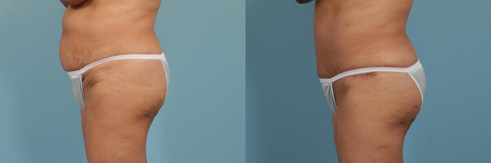 Before & After Tummy Tuck by Dr. Mustoe Case 266 View #2 View in Chicago, IL