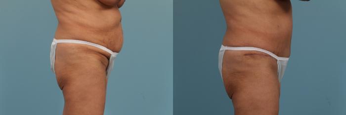 Before & After Tummy Tuck by Dr. Mustoe Case 266 View #3 View in Chicago, IL