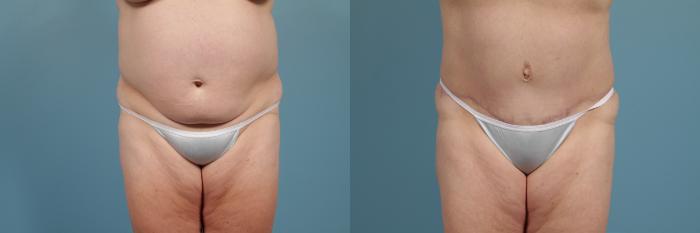 Before & After Tummy Tuck by Dr. Mustoe Case 272 View #1 View in Chicago, IL