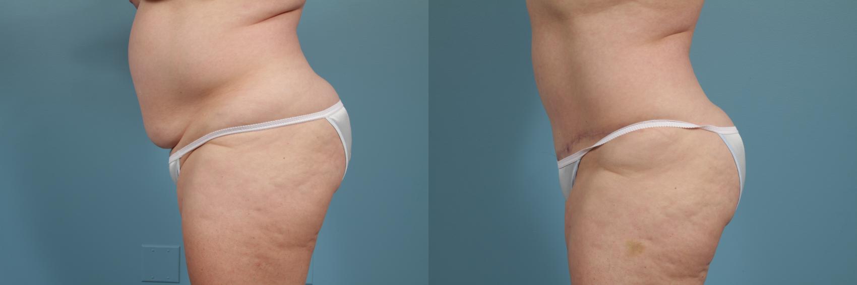 Before & After Tummy Tuck by Dr. Mustoe Case 272 View #2 View in Chicago, IL