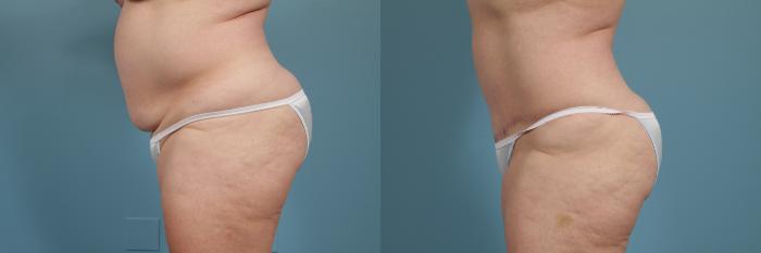 Before & After Tummy Tuck by Dr. Mustoe Case 272 View #2 View in Chicago, IL