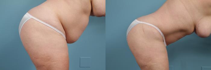 Before & After Tummy Tuck by Dr. Mustoe Case 272 View #3 View in Chicago, IL