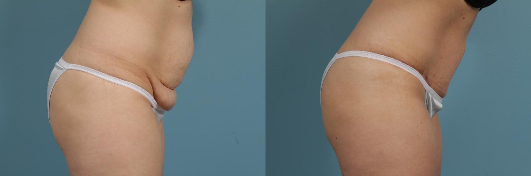 Before & After Tummy Tuck by Dr. Mustoe Case 283 View #3 View in Chicago, IL