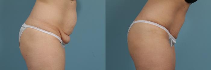 Before & After Tummy Tuck by Dr. Mustoe Case 283 View #3 View in Chicago, IL