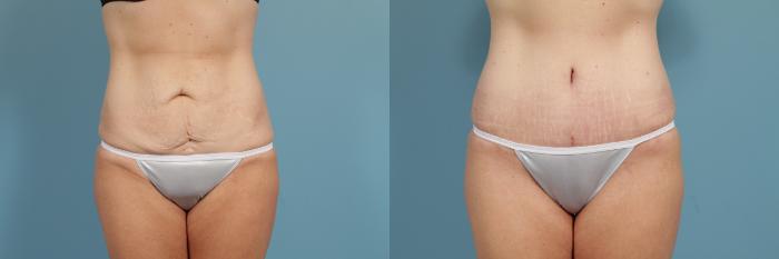 Before & After Tummy Tuck by Dr. Mustoe Case 293 View #1 View in Chicago, IL