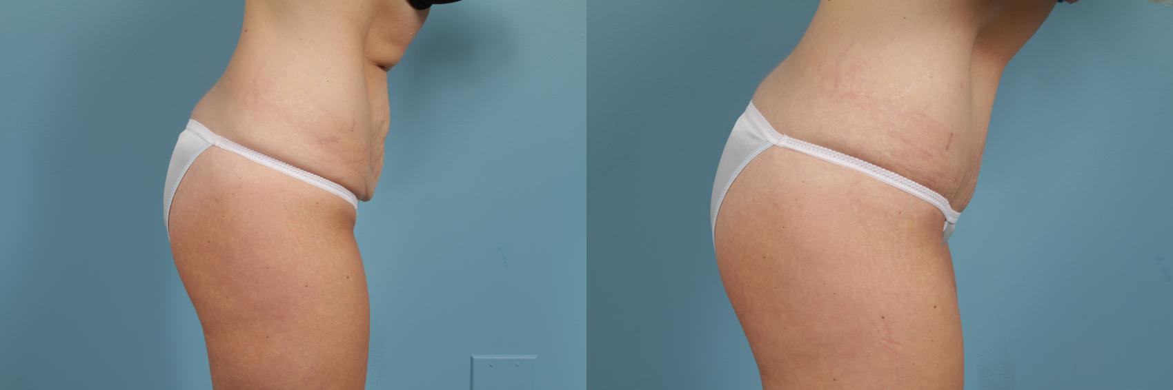 Before & After Tummy Tuck by Dr. Mustoe Case 293 View #3 View in Chicago, IL