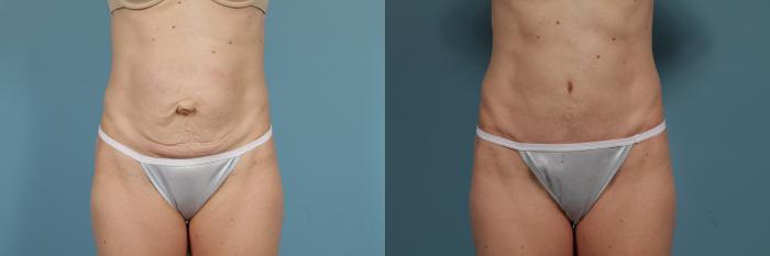 Before & After Tummy Tuck by Dr. Mustoe Case 294 View #1 View in Chicago, IL