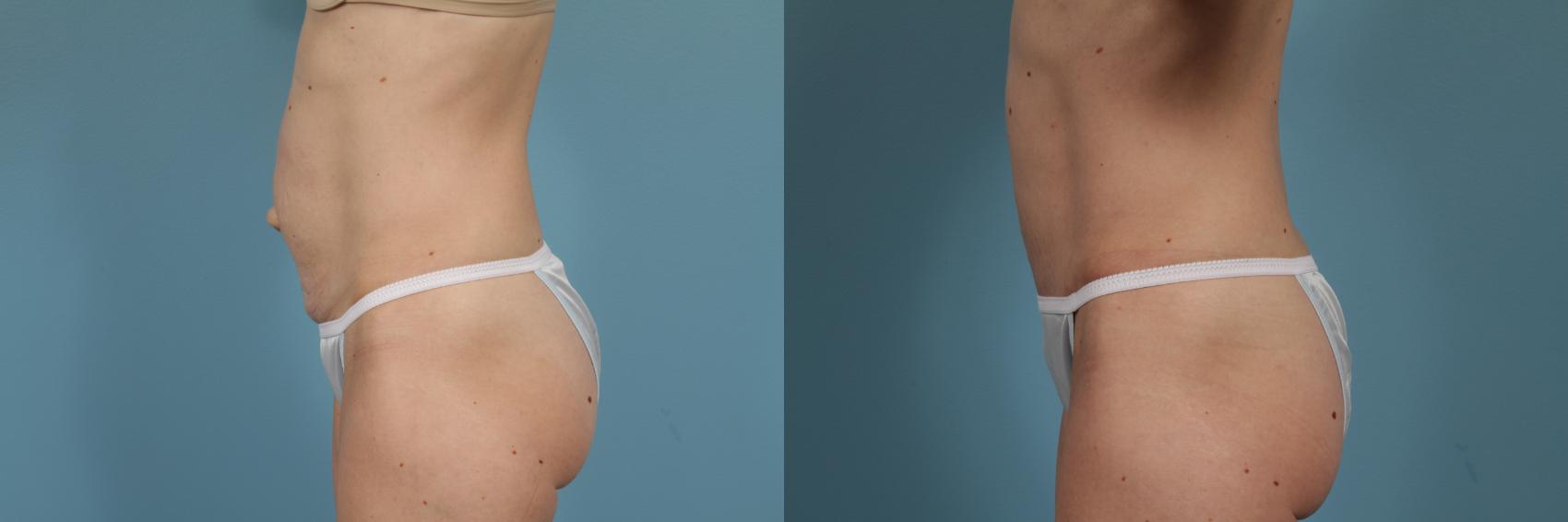 Before & After Tummy Tuck by Dr. Mustoe Case 294 View #2 View in Chicago, IL