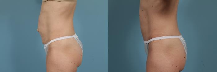 Before & After Tummy Tuck by Dr. Mustoe Case 294 View #2 View in Chicago, IL