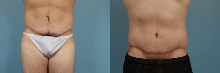 Before & After Tummy Tuck by Dr. Mustoe Case 296 View #1 View in Chicago, IL