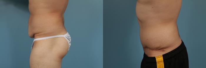 Before & After Tummy Tuck by Dr. Mustoe Case 296 View #2 View in Chicago, IL