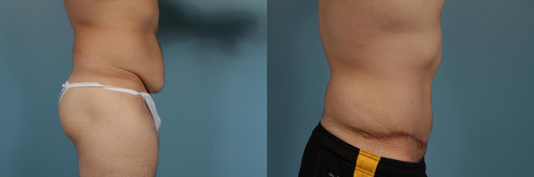Before & After Tummy Tuck by Dr. Mustoe Case 296 View #3 View in Chicago, IL