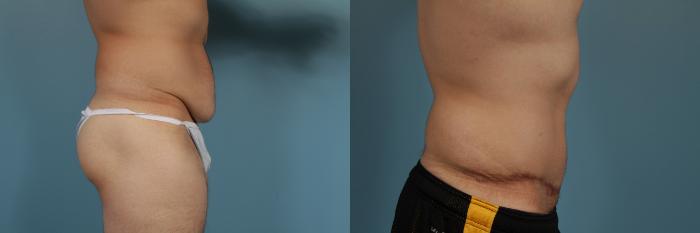 Before & After Tummy Tuck by Dr. Mustoe Case 296 View #3 View in Chicago, IL