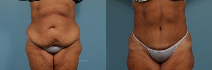 Before & After Tummy Tuck by Dr. Mustoe Case 297 View #1 View in Chicago, IL