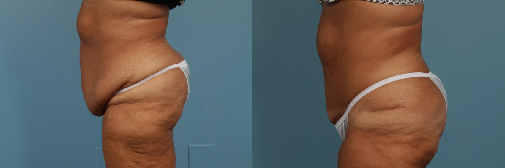 Before & After Tummy Tuck by Dr. Mustoe Case 297 View #2 View in Chicago, IL