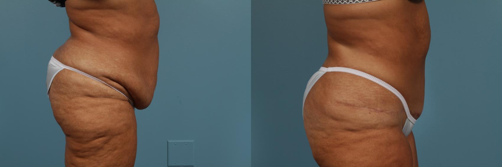 Before & After Tummy Tuck by Dr. Mustoe Case 297 View #3 View in Chicago, IL