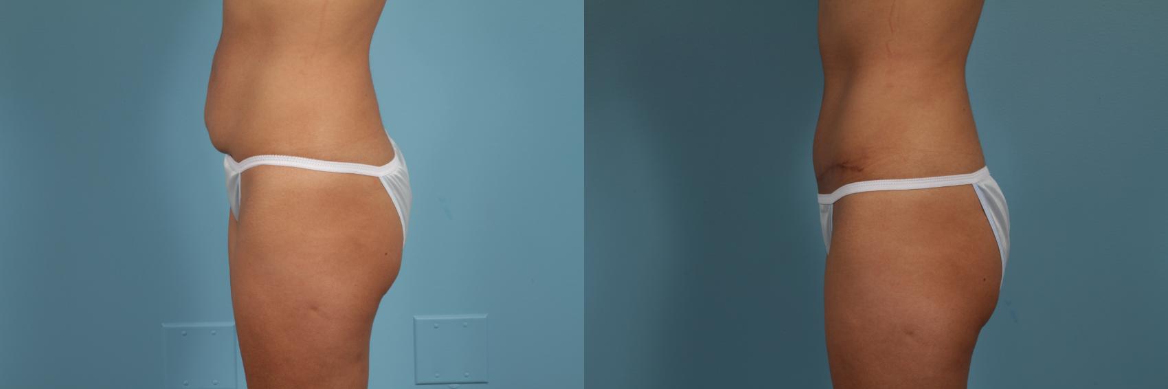 Before & After Tummy Tuck by Dr. Mustoe Case 298 View #2 View in Chicago, IL