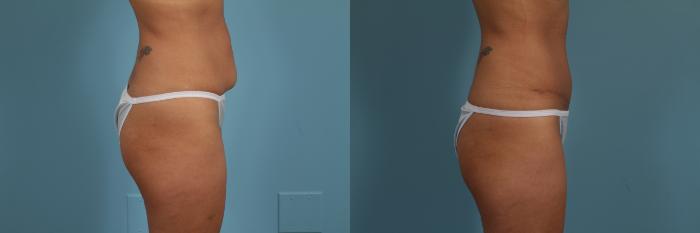 Before & After Tummy Tuck by Dr. Mustoe Case 298 View #3 View in Chicago, IL