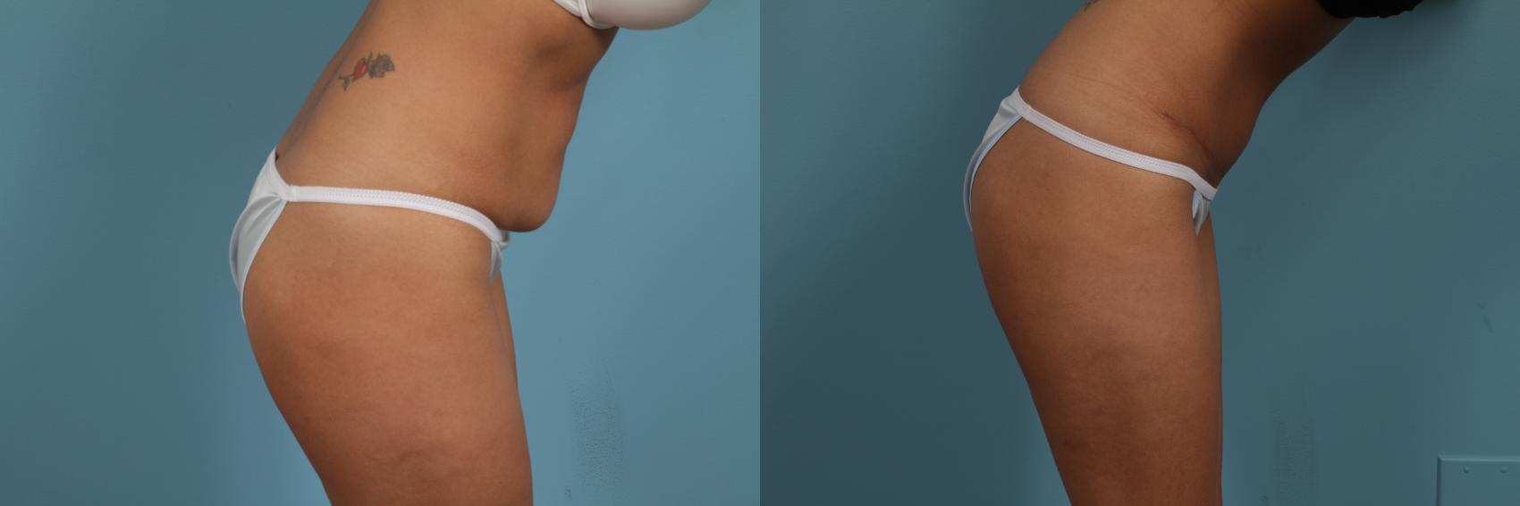 Before & After Tummy Tuck by Dr. Mustoe Case 298 View #4 View in Chicago, IL