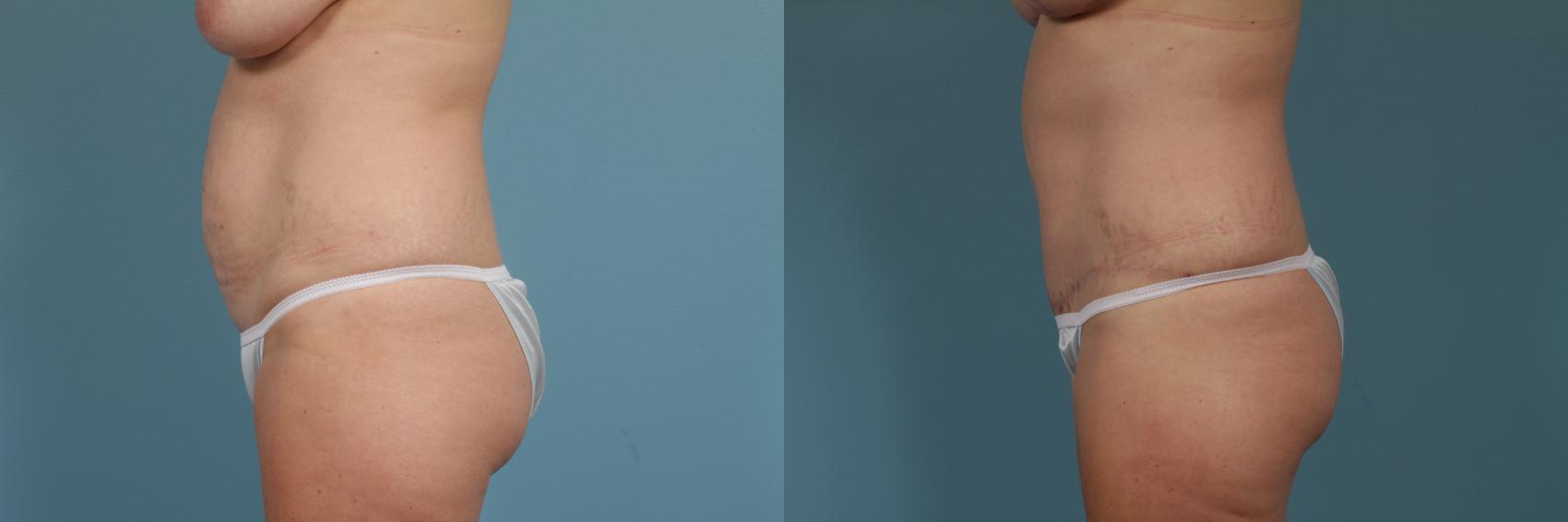 Before & After Tummy Tuck by Dr. Mustoe Case 310 View #2 View in Chicago, IL