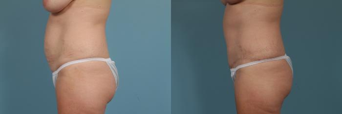 Before & After Tummy Tuck by Dr. Mustoe Case 310 View #2 View in Chicago, IL
