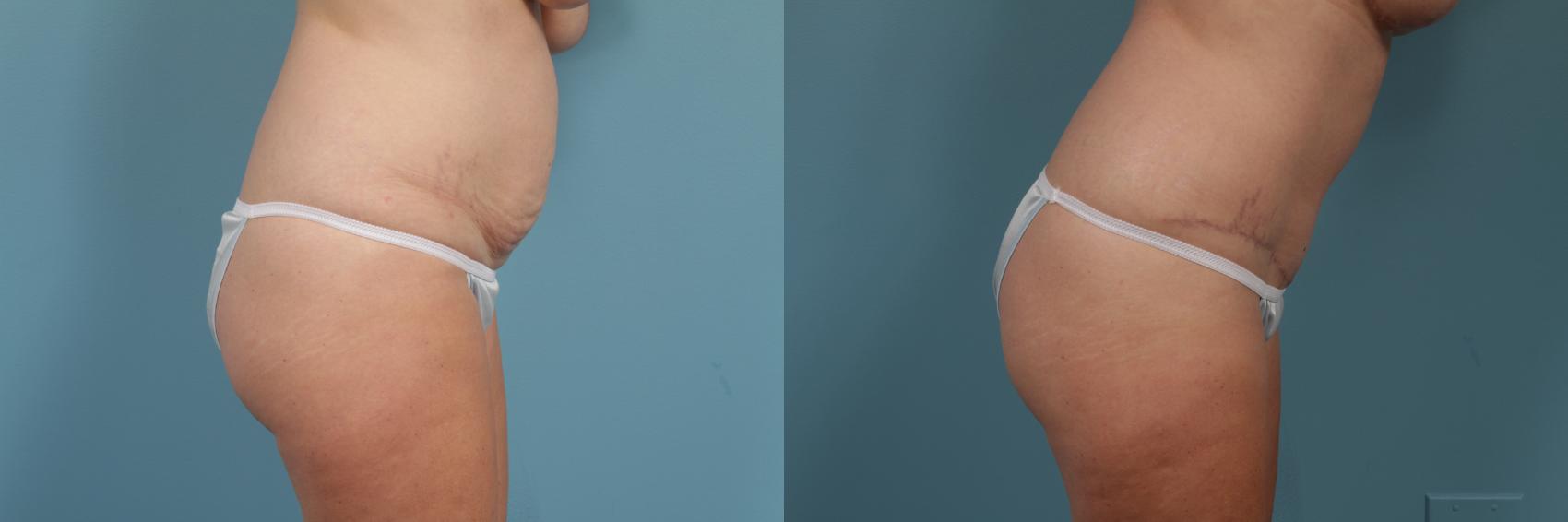 Before & After Tummy Tuck by Dr. Mustoe Case 310 View #3 View in Chicago, IL