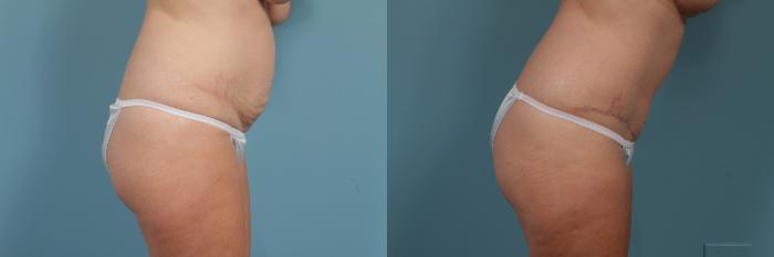 Before & After Tummy Tuck by Dr. Mustoe Case 310 View #3 View in Chicago, IL