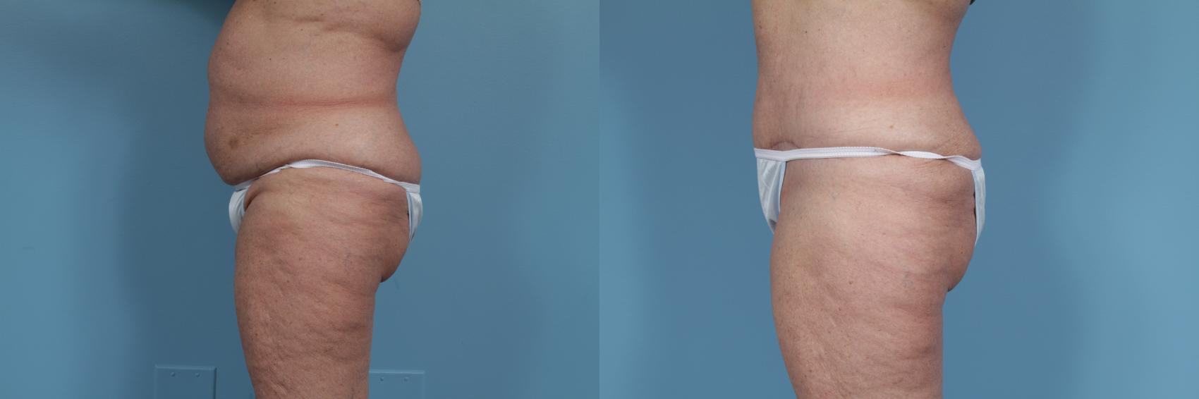 Before & After Tummy Tuck by Dr. Mustoe Case 354 View #2 View in Chicago, IL