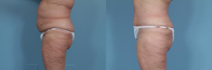 Before & After Tummy Tuck by Dr. Mustoe Case 354 View #2 View in Chicago, IL
