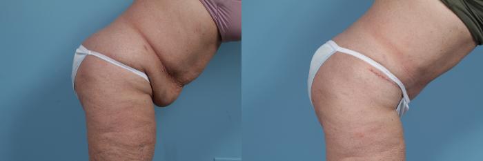 Before & After Tummy Tuck by Dr. Mustoe Case 354 View #3 View in Chicago, IL