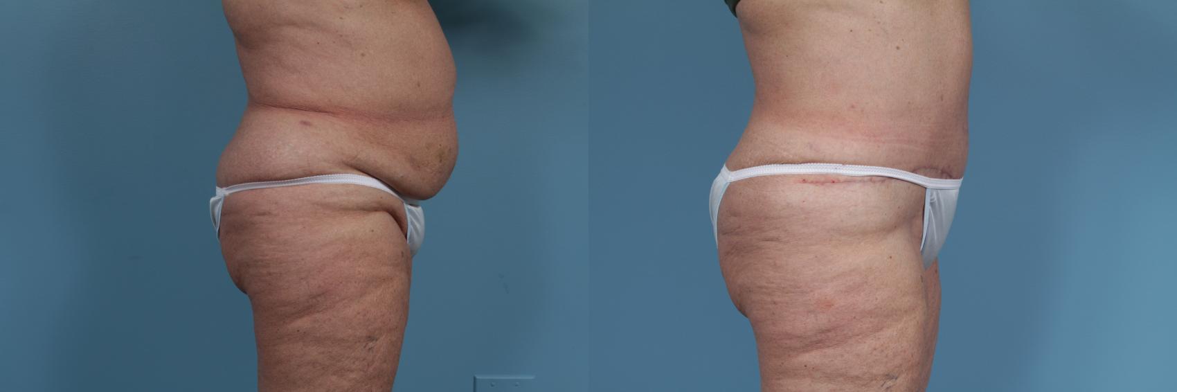 Before & After Tummy Tuck by Dr. Mustoe Case 354 View #4 View in Chicago, IL