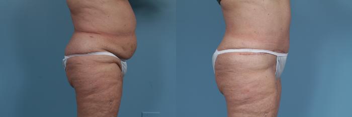 Before & After Tummy Tuck by Dr. Mustoe Case 354 View #4 View in Chicago, IL