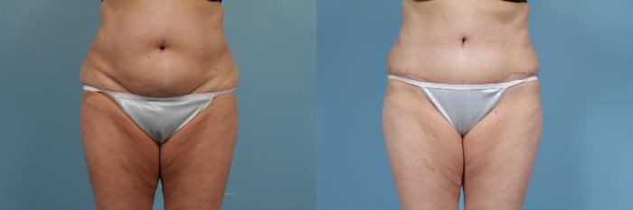 Before & After Tummy Tuck by Dr. Mustoe Case 355 View #1 View in Chicago, IL
