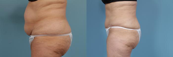 Before & After Tummy Tuck by Dr. Mustoe Case 355 View #2 View in Chicago, IL