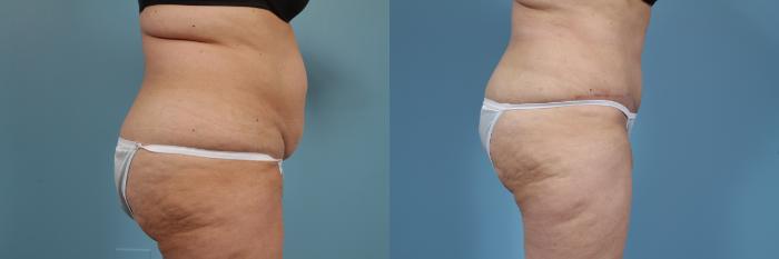 Before & After Tummy Tuck by Dr. Mustoe Case 355 View #3 View in Chicago, IL
